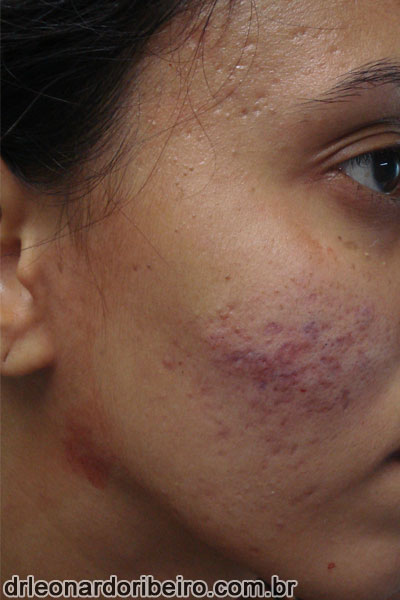Acne | Dermatologista em Natal | Dr Leonardo Ribeiro