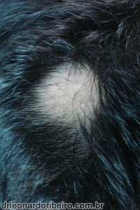 alopecia