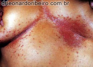 candidiase