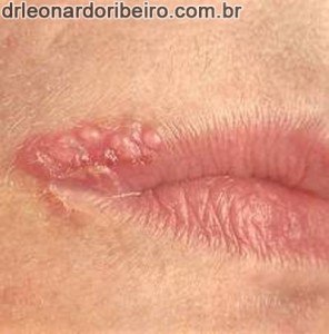 herpes-simples