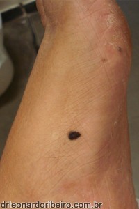 melanoma