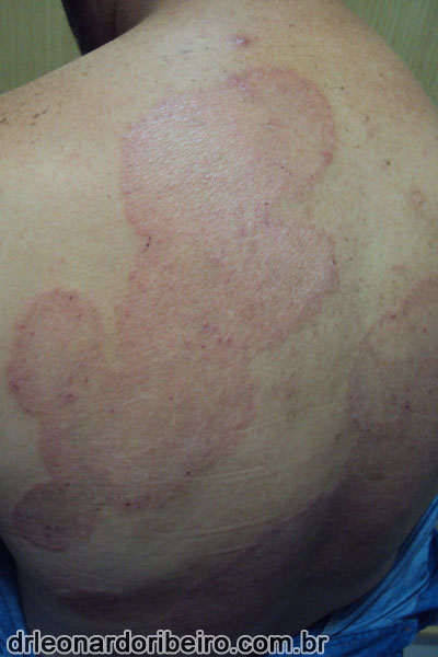 Micoses (Tineas), Dermatologista em Natal