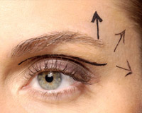 Blefaroplastia